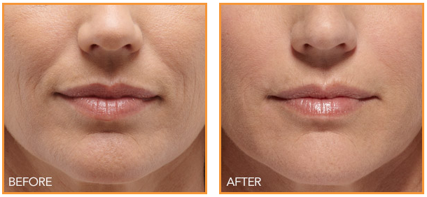 Filler for Nasolabial Folds, Under the Eyes & More: What It Can Do for You | MI Skin Dermatology Center: Melda Isaac, MD
