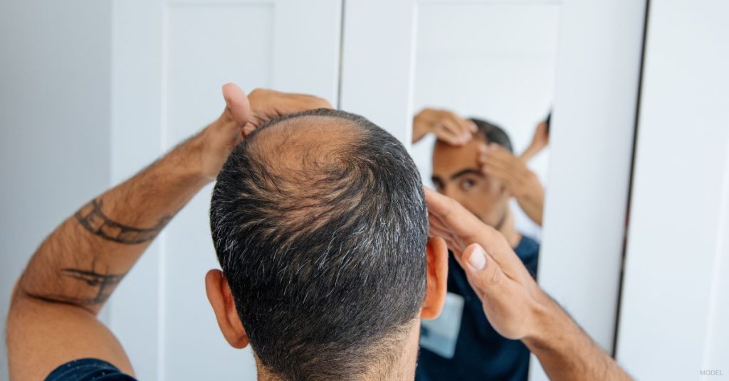 man (MODEL) looking in mirror looking at his balding hair